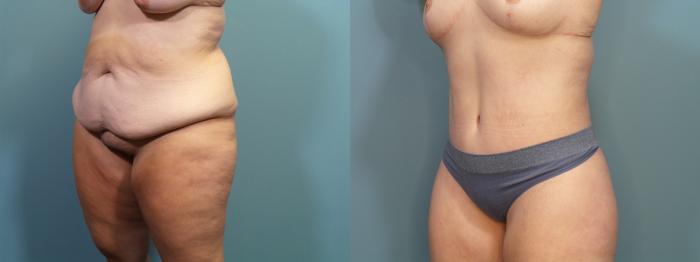 Before & After Tummy Tuck (Abdominoplasty) Case 366 Left Oblique View in Portland, OR