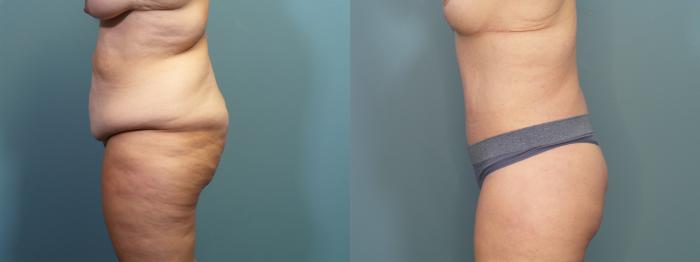 Before & After Tummy Tuck (Abdominoplasty) Case 366 Left Side View in Portland, OR