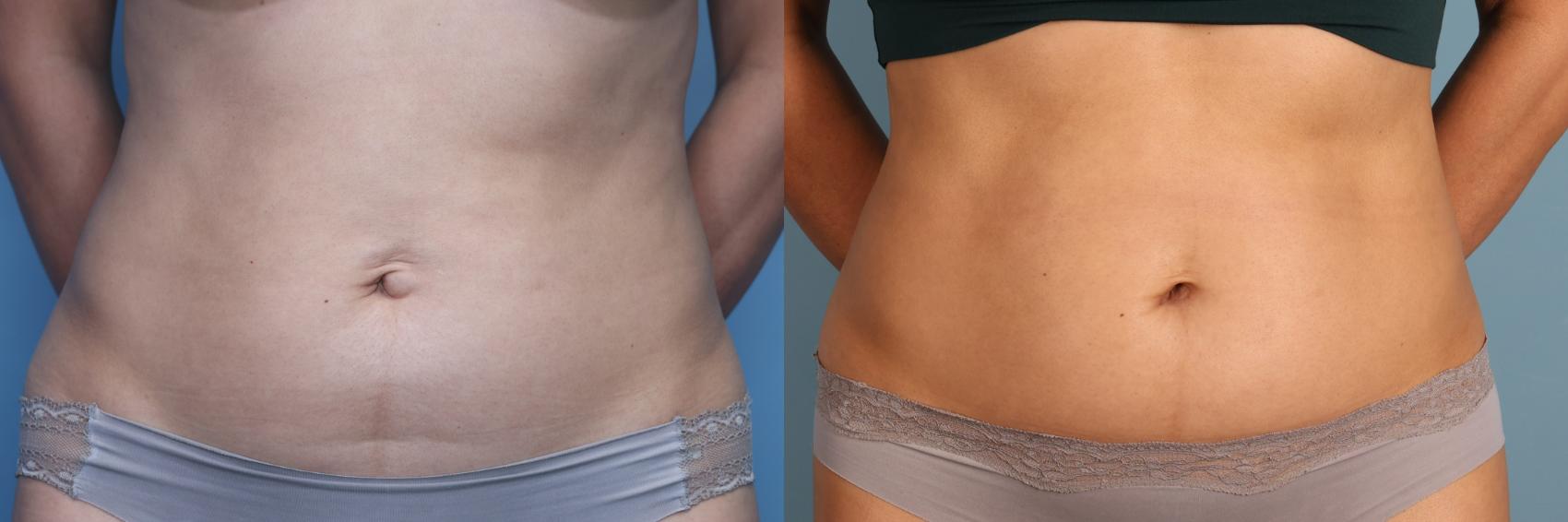 Before & After Tummy Tuck (Abdominoplasty) Case 391 Front View in Portland, OR