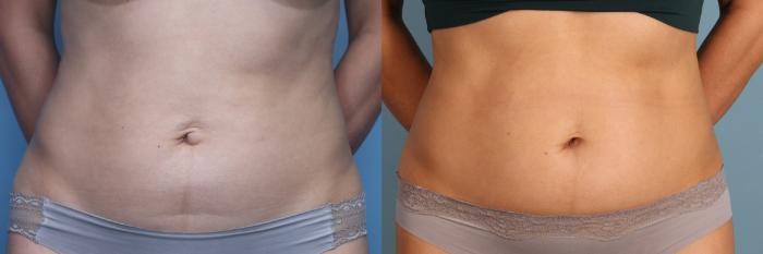 Before & After Tummy Tuck (Abdominoplasty) Case 391 Front View in Portland, OR