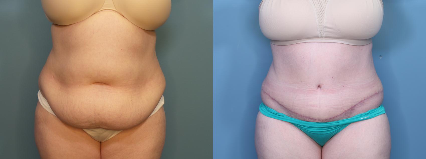 Before & After Tummy Tuck (Abdominoplasty) Case 405 Front View in Portland, OR