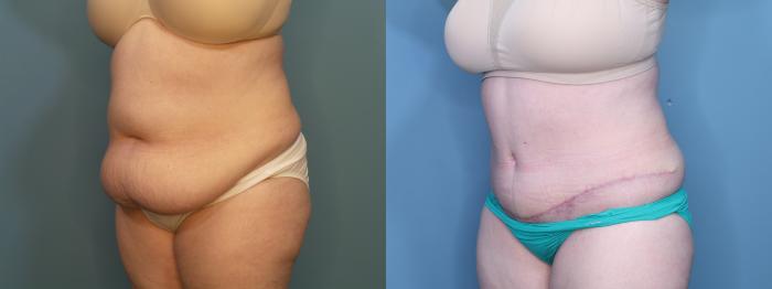 Before & After Tummy Tuck (Abdominoplasty) Case 405 Left Oblique View in Portland, OR