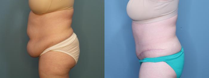 Before & After Tummy Tuck (Abdominoplasty) Case 405 Left Side View in Portland, OR
