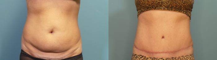 Before & After Tummy Tuck (Abdominoplasty) Case 418 Front View in Portland, OR