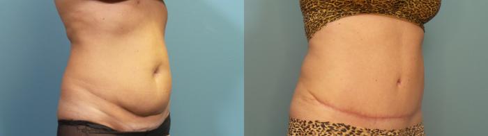 Before & After Tummy Tuck (Abdominoplasty) Case 418 Right Oblique View in Portland, OR