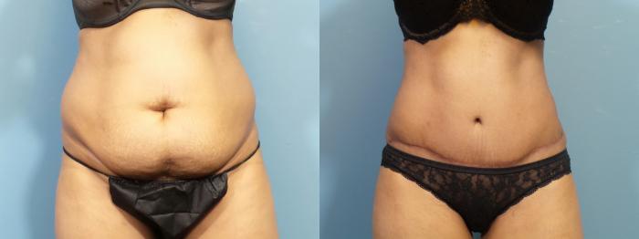 Before & After Liposuction Case 420 Front View in Portland, OR