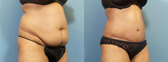 Before & After Tummy Tuck (Abdominoplasty) Case 420 Right Oblique View in Portland, OR