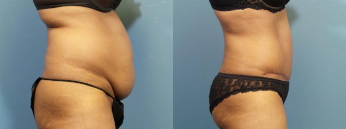 Before & After Liposuction Case 420 Right Side View in Portland, OR
