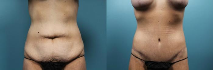 Before & After Tummy Tuck (Abdominoplasty) Case 60 View #1 View in Portland, OR