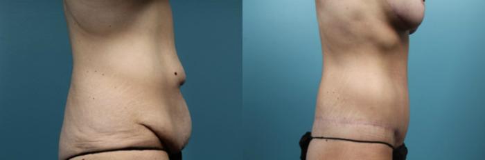 Before & After Tummy Tuck (Abdominoplasty) Case 60 View #2 View in Portland, OR