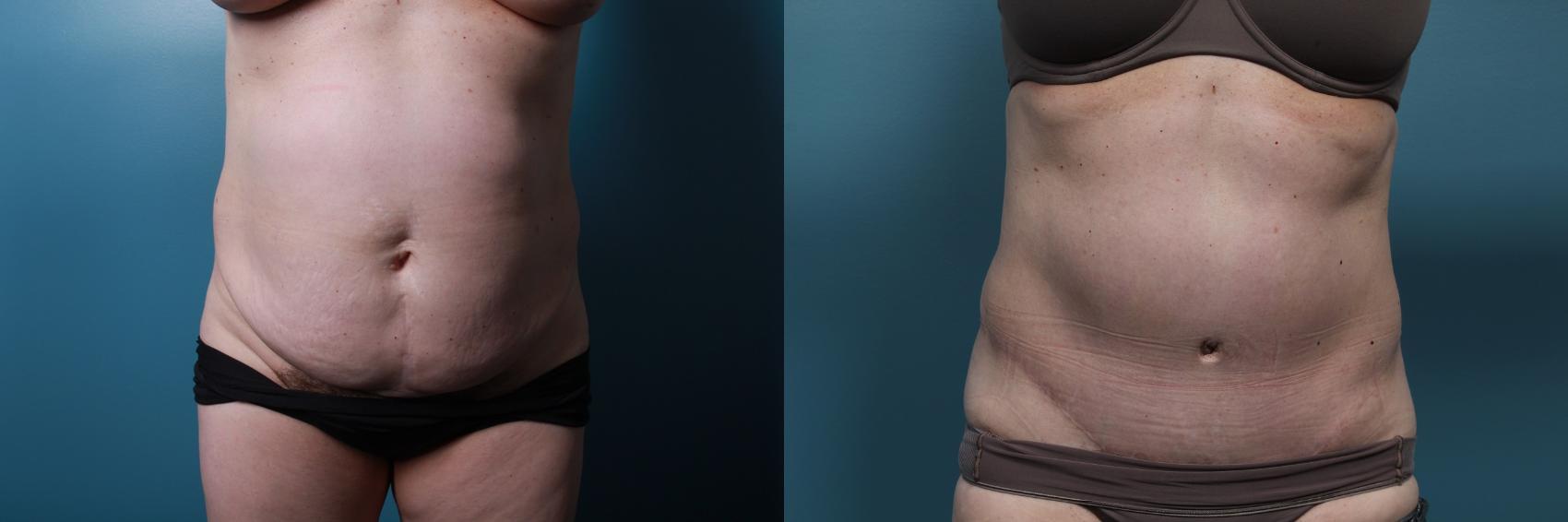 Before & After Tummy Tuck (Abdominoplasty) Case 65 View #1 View in Portland, OR