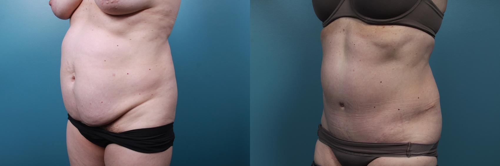Before & After Tummy Tuck (Abdominoplasty) Case 65 View #2 View in Portland, OR