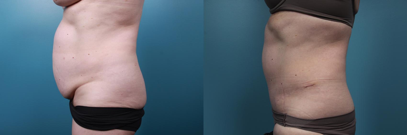 Before & After Tummy Tuck (Abdominoplasty) Case 65 View #3 View in Portland, OR
