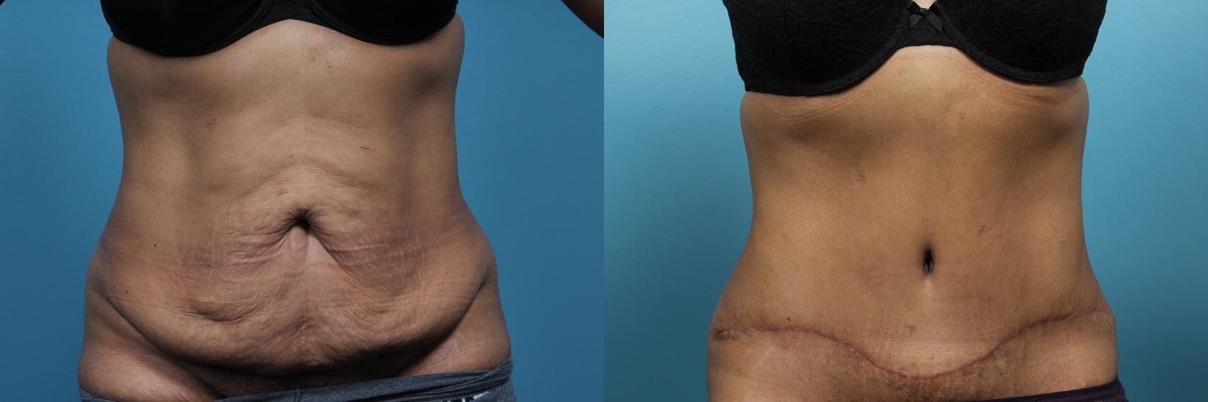 Before & After Tummy Tuck (Abdominoplasty) Case 70 View #1 View in Portland, OR