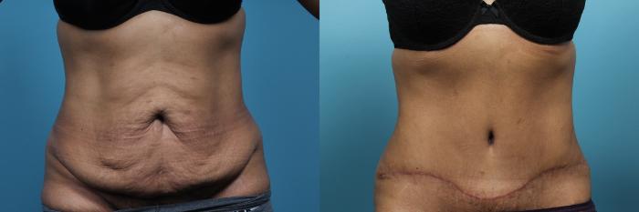 Abdominoplasty Before and After