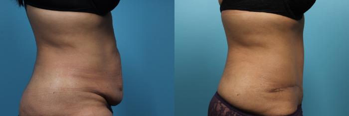 Before & After Tummy Tuck (Abdominoplasty) Case 70 View #2 View in Portland, OR