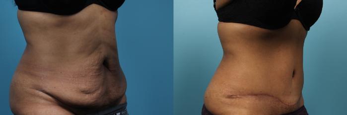 Before & After Tummy Tuck (Abdominoplasty) Case 70 View #3 View in Portland, OR