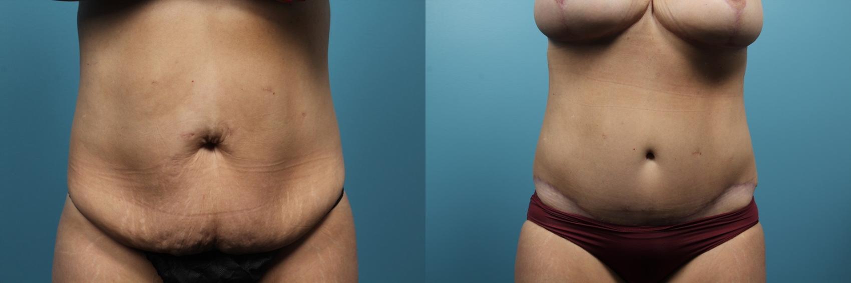Before & After Tummy Tuck (Abdominoplasty) Case 80 View #1 View in Portland, OR
