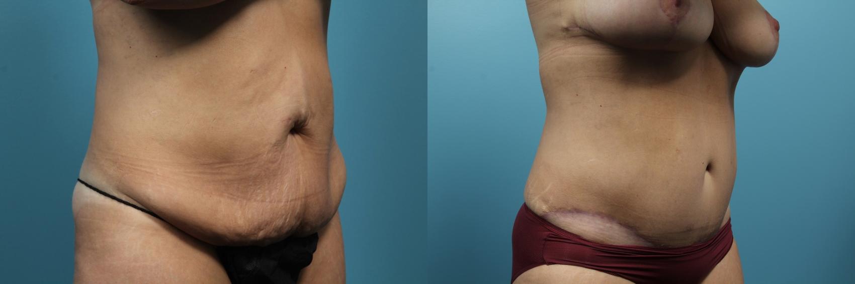 Before & After Tummy Tuck (Abdominoplasty) Case 80 View #2 View in Portland, OR