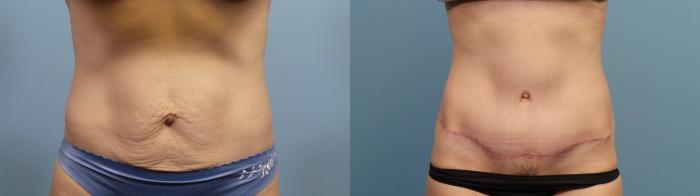 Before & After Tummy Tuck (Abdominoplasty) Case 85 View #1 View in Portland, OR