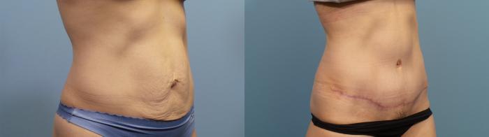 Before & After Tummy Tuck (Abdominoplasty) Case 85 View #2 View in Portland, OR